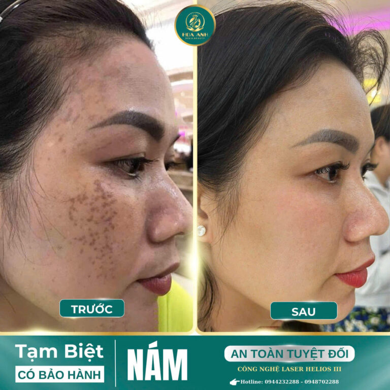 Ảnh trước và sau điều trị nám mảng bằng công nghệ Laser Helios III tại Hoa Anh