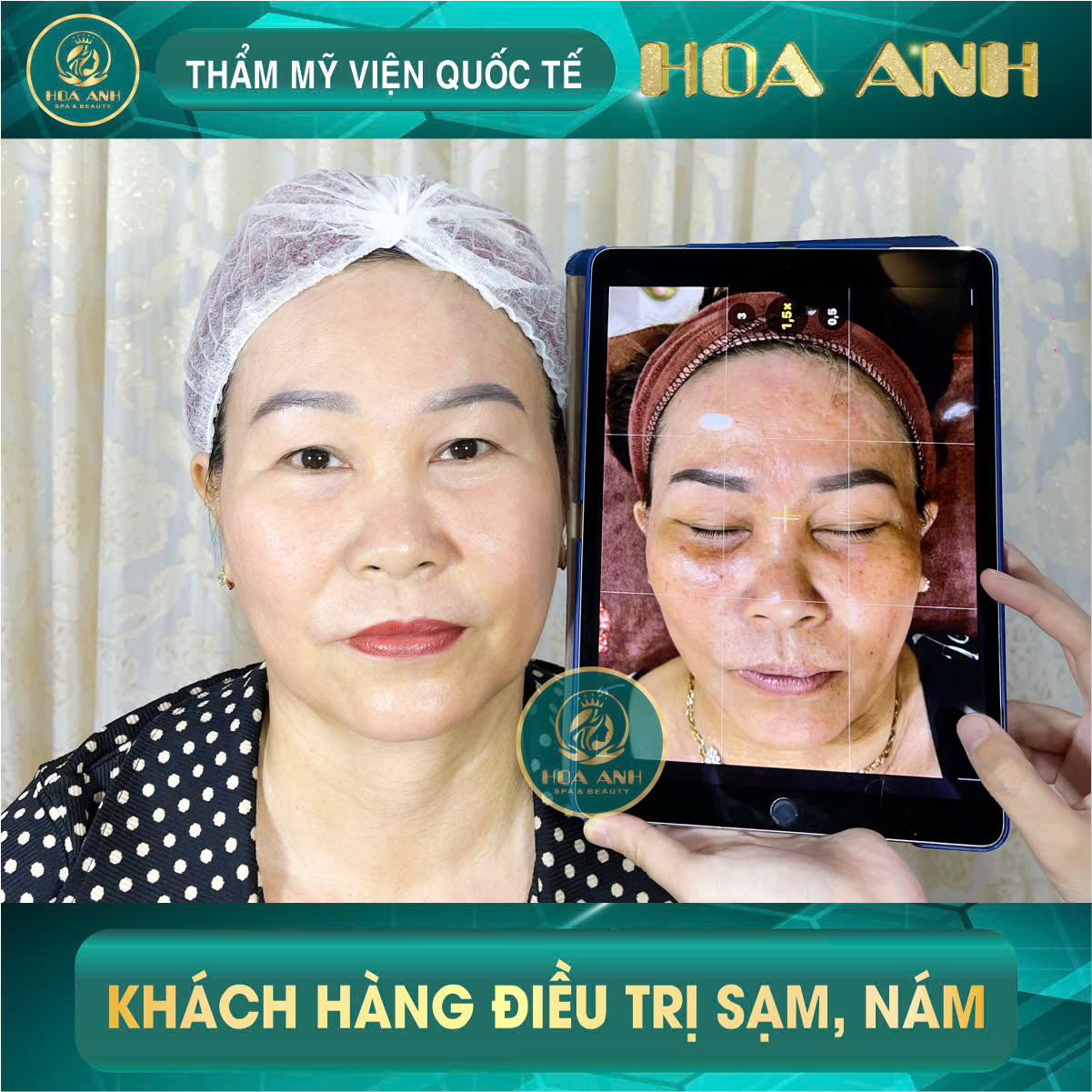 Khách hàng điều trị sạm, nám tại Hoa Anh, soi da trước khi lên phác đồ