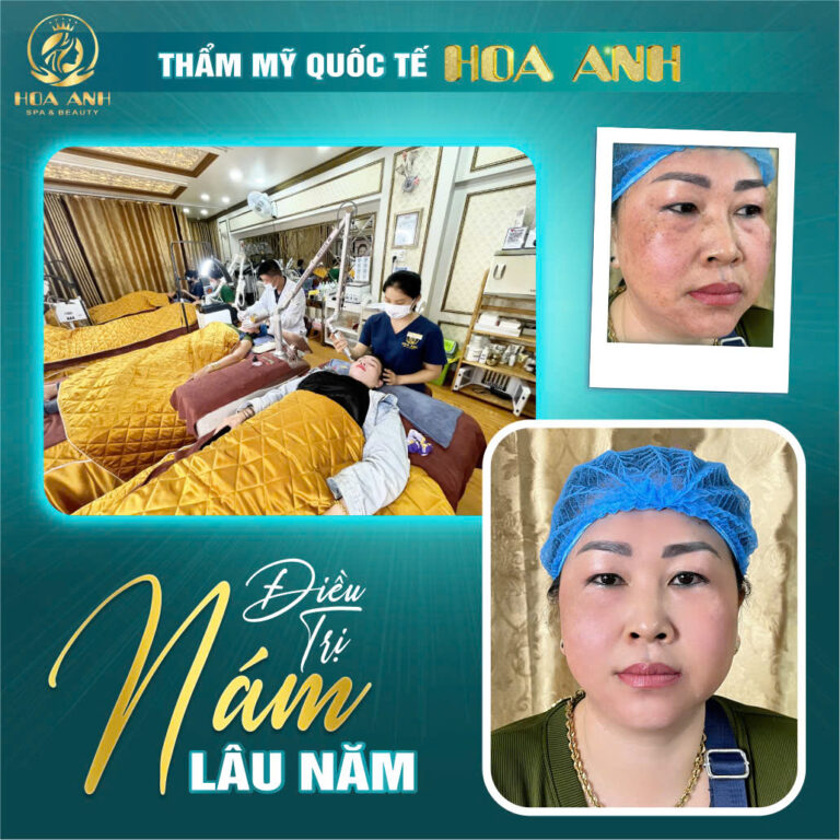 Ảnh trước và sau điều trị nám, sạm da bằng công nghệ Laser Helios III tại Hoa Anh