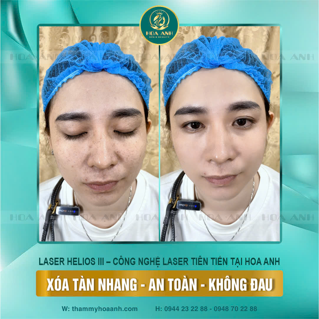 Ảnh trước và sau điều trị tàn nhang tại Hoa Anh, an toàn và không đau