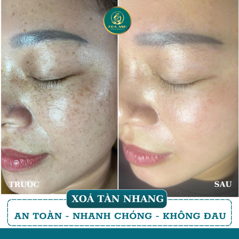Ảnh trước và sau xóa tàn nhang, an toàn nhanh chóng không đau tại Hoa Anh