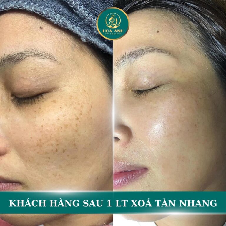 Ảnh khách hàng sau 1 liệu trình xóa tàn nhang tại Hoa Anh